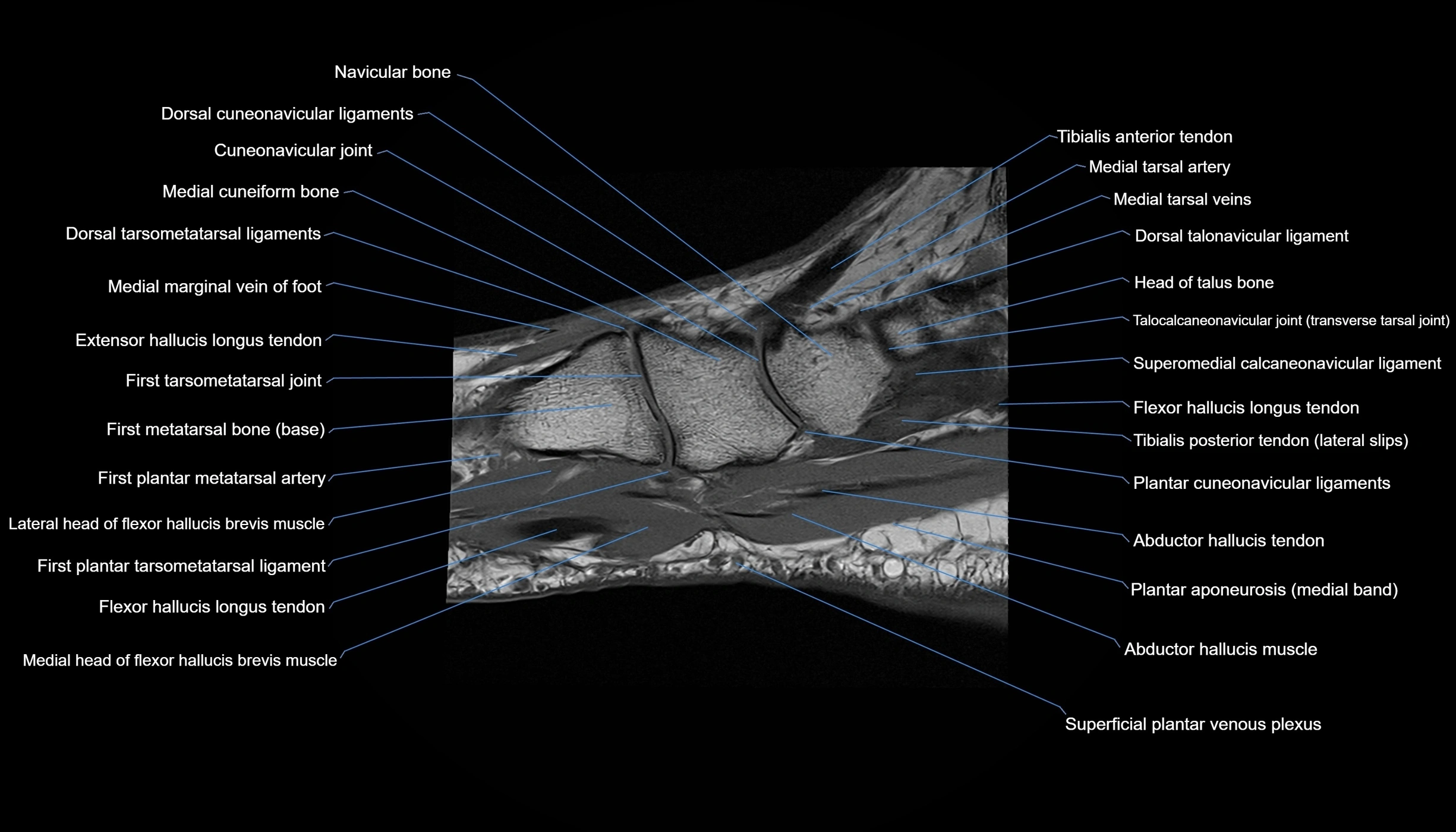 MRI mid foot sagittal cross sectional anatomy 3T  radiology  image-img-00001-00033.webp